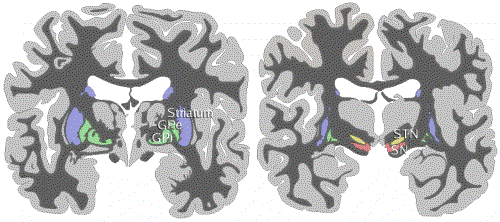 Coronal section of the brain showing the basal ganglia and sites used in ablative surgery to treat Parkinson’s disease. Blue=striatum, green=globus pallidus (external and internal segments), yellow=subthalamic nucleus, red=substantia nigra.
